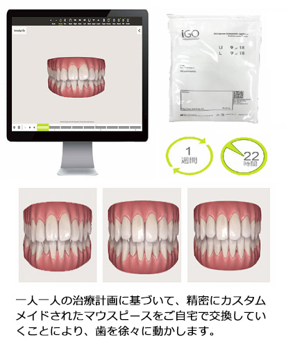 インビザラインGO