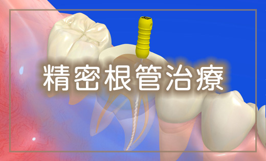 根管治療