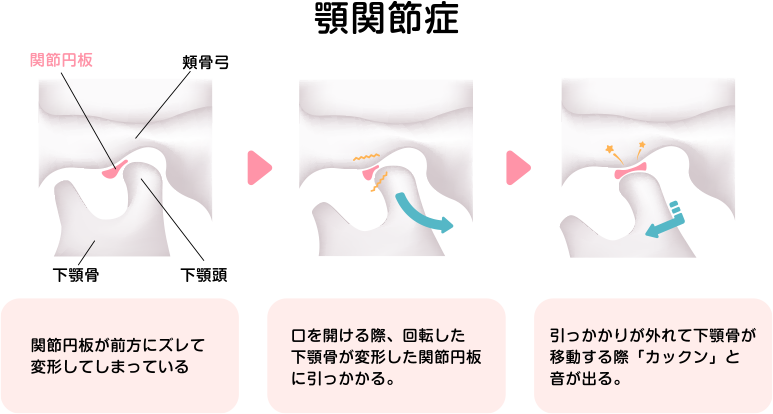 顎関節症治療｜藤枝市 時ケ谷歯科クリニック ＜歯科・小児歯科・歯周病